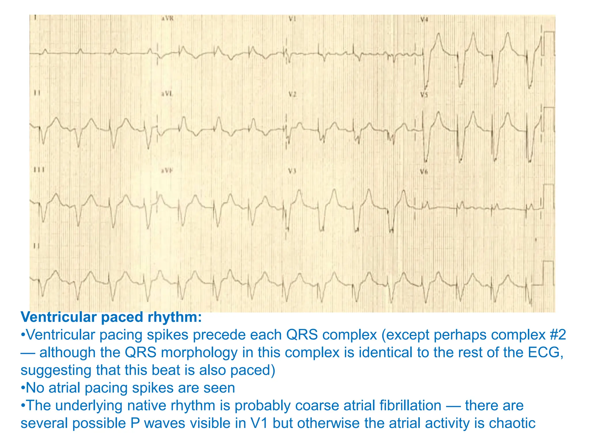 Ventricular paced rhythm:
•Ventricular pacing spikes precede each QRS complex (except perhaps complex #2
— although the QRS morphology in this complex is identical to the rest of the ECG,
suggesting that this beat is also paced)
•No atrial pacing spikes are seen
•The underlying native rhythm is probably coarse atrial fibrillation — there are
several possible P waves visible in V1 but otherwise the atrial activity is chaotic
 