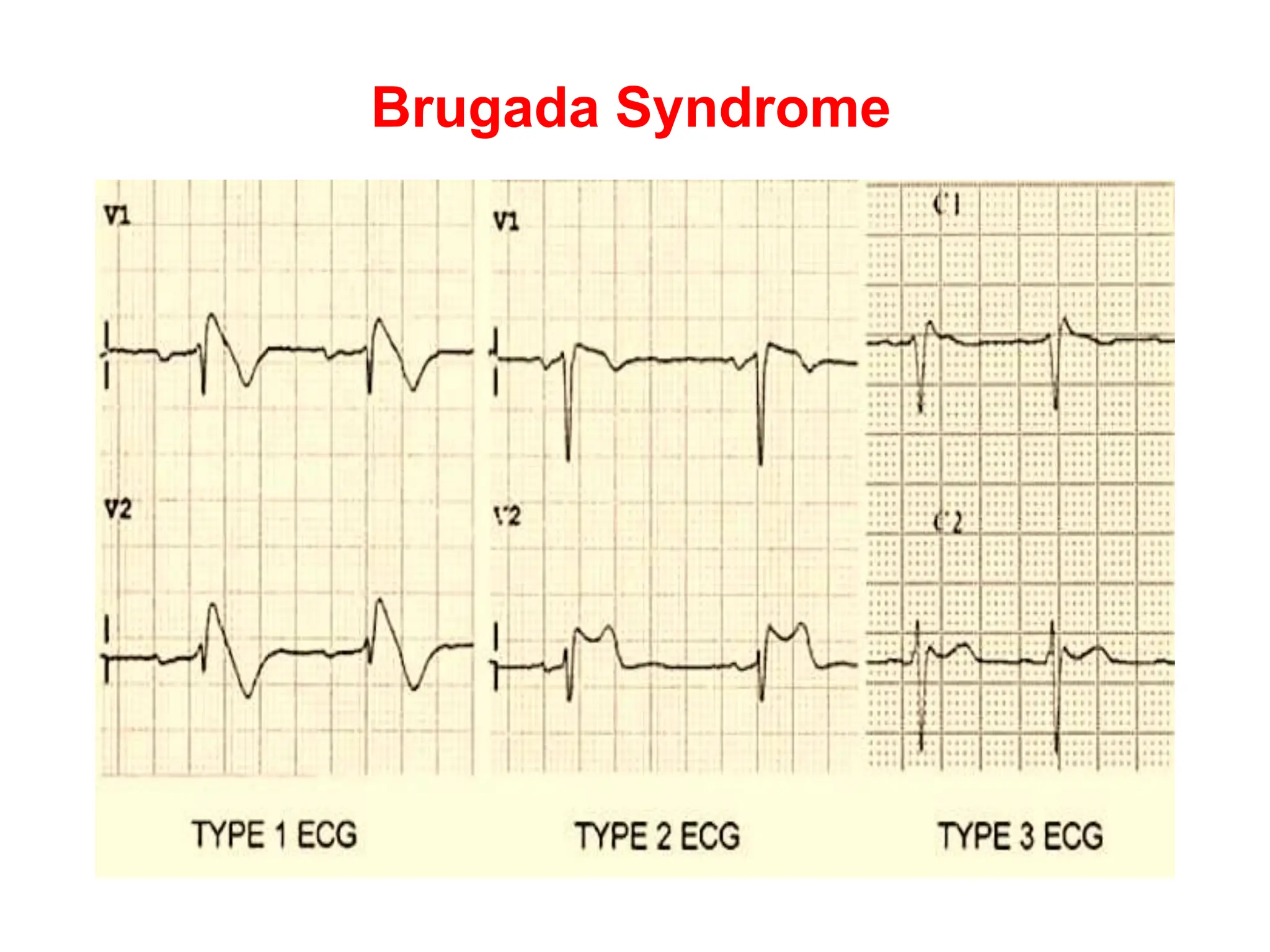Brugada Syndrome
 
