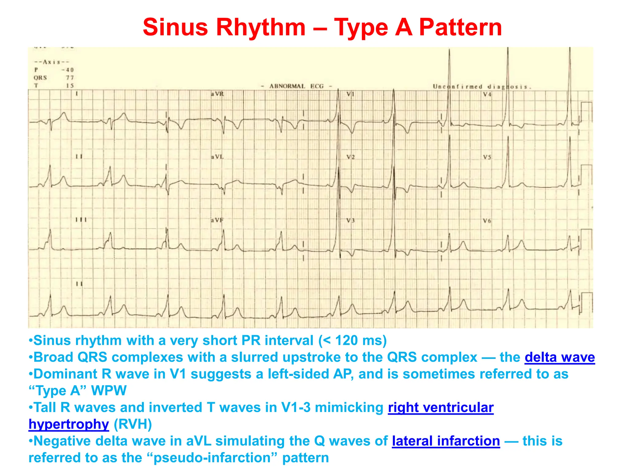 Sinus Rhythm – Type A Pattern
•Sinus rhythm with a very short PR interval (< 120 ms)
•Broad QRS complexes with a slurred upstroke to the QRS complex — the delta wave
•Dominant R wave in V1 suggests a left-sided AP, and is sometimes referred to as
“Type A” WPW
•Tall R waves and inverted T waves in V1-3 mimicking right ventricular
hypertrophy (RVH)
•Negative delta wave in aVL simulating the Q waves of lateral infarction — this is
referred to as the “pseudo-infarction” pattern
 