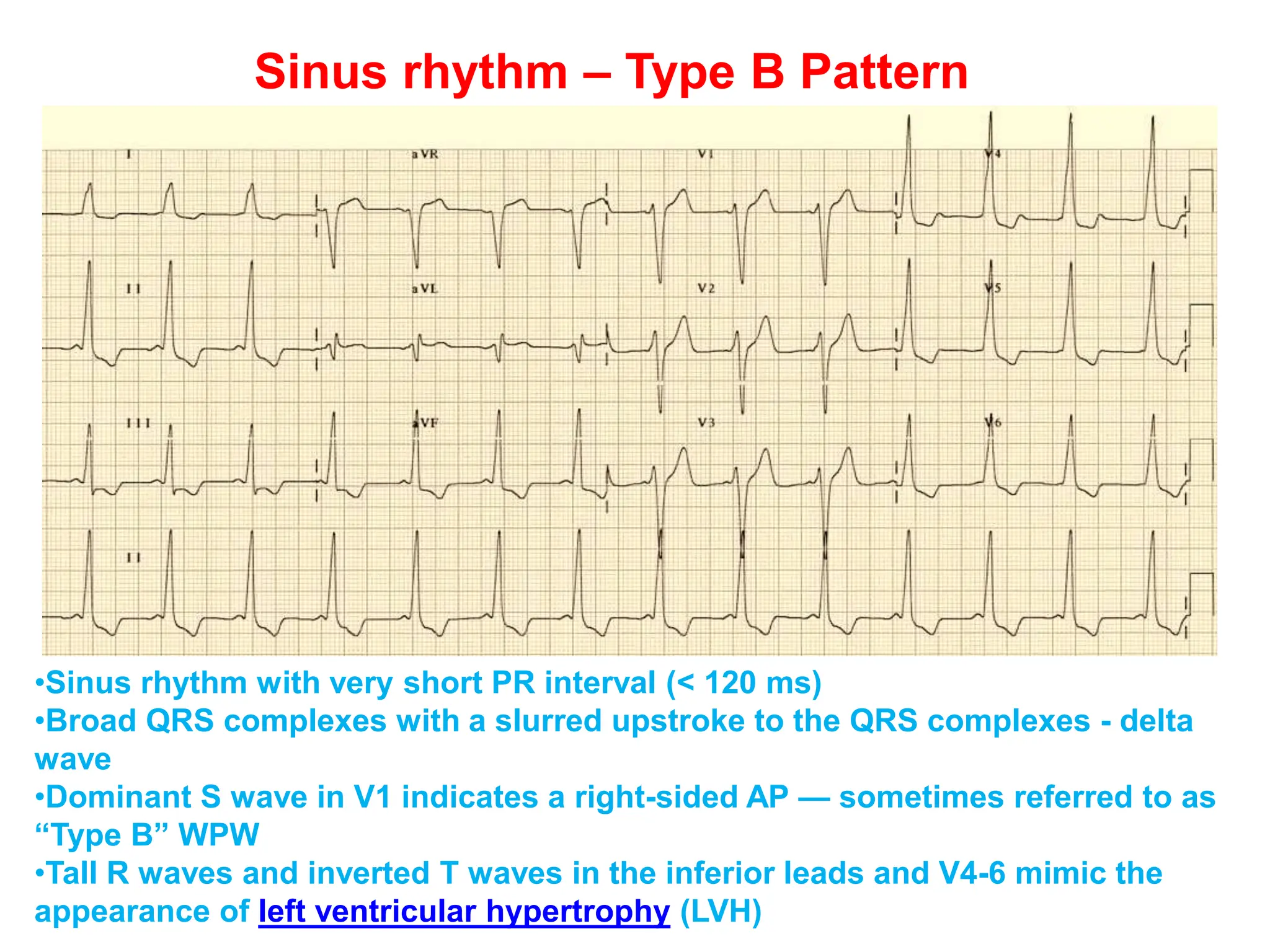 Sinus rhythm – Type B Pattern
•Sinus rhythm with very short PR interval (< 120 ms)
•Broad QRS complexes with a slurred upstroke to the QRS complexes - delta
wave
•Dominant S wave in V1 indicates a right-sided AP — sometimes referred to as
“Type B” WPW
•Tall R waves and inverted T waves in the inferior leads and V4-6 mimic the
appearance of left ventricular hypertrophy (LVH)
 