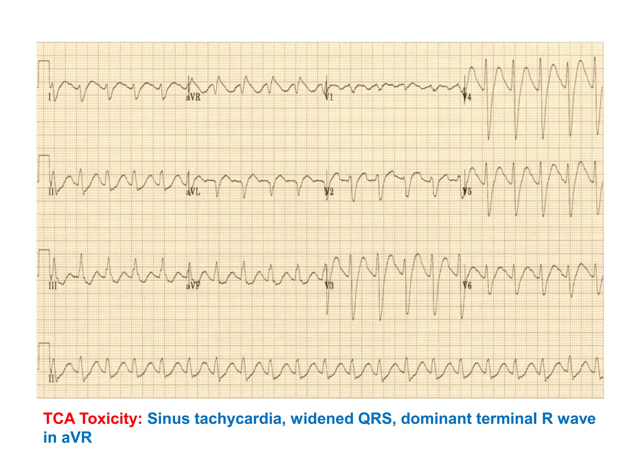 TCA Toxicity: Sinus tachycardia, widened QRS, dominant terminal R wave
in aVR
 