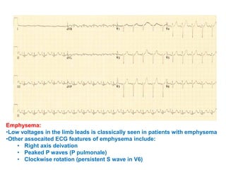 Extreme Counterclockwise Rotation Ecg QRS INTERVAL IN ECG AND ITS ABNORMALITIES | PPTX