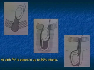 At birth PV is patent in up to 80% infants.At birth PV is patent in up to 80% infants.
 