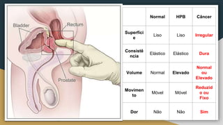 Normal HPB Câncer
Superfíci
e
Liso Liso Irregular
Consistê
ncia
Elástico Elástico Dura
Volume Normal Elevado
Normal
ou
Elevado
Movimen
to
Móvel Móvel
Reduzid
o ou
Fixo
Dor Não Não Sim
 