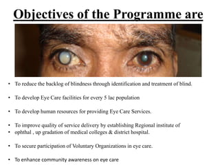 Objectives of the Programme are
• To reduce the backlog of blindness through identification and treatment of blind.
• To develop Eye Care facilities for every 5 lac population
• To develop human resources for providing Eye Care Services.
• To improve quality of service delivery by establishing Regional institute of
• ophthal , up gradation of medical colleges & district hospital.
• To secure participation of Voluntary Organizations in eye care.
• To enhance community awareness on eye care
 