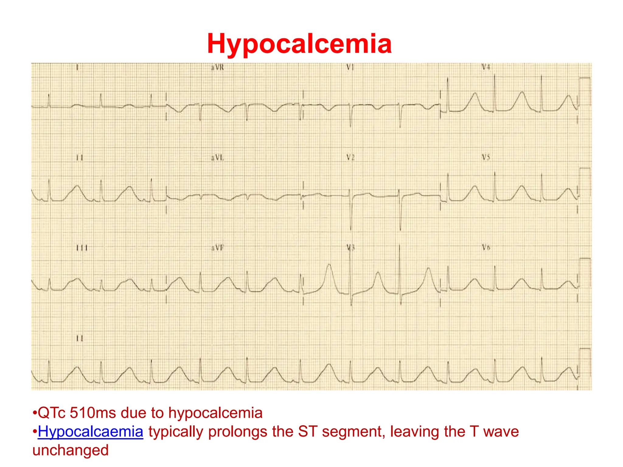Hypocalcemia
•QTc 510ms due to hypocalcemia
•Hypocalcaemia typically prolongs the ST segment, leaving the T wave
unchanged
 