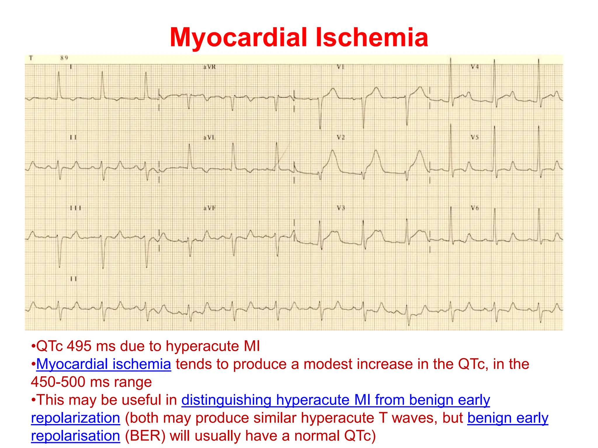 Myocardial Ischemia
•QTc 495 ms due to hyperacute MI
•Myocardial ischemia tends to produce a modest increase in the QTc, in the
450-500 ms range
•This may be useful in distinguishing hyperacute MI from benign early
repolarization (both may produce similar hyperacute T waves, but benign early
repolarisation (BER) will usually have a normal QTc)
 