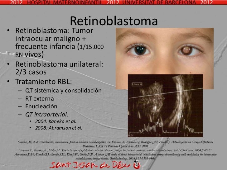 Quimioterapia intraarterial para el retinoblastoma