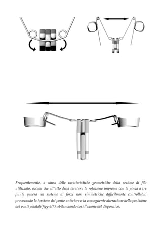 Frequentemente, a causa delle caratteristiche geometriche della sezione di filo
utilizzato, accade che all'atto della taratura la rotazione impressa con la pinza a tre
punte genera un sisteme di forze non simmetriche difficilmente controllabili
provocando la torsione del ponte anteriore e la conseguente alterazione della posizione
dei ponti palatali(figg.6/7), sbilanciando così l'azione del dispositivo.
fig.3 fig.4
fig.5
 