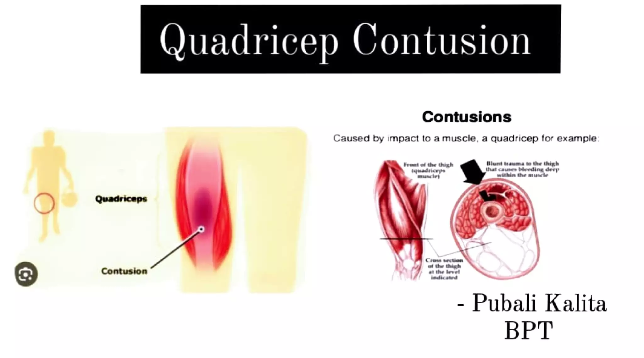 Quadricep Contusion.pdf
