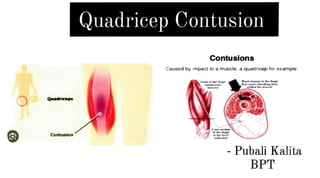COntU51on
Quadricep Contusion
Contusions
Caused by impac t to a muscle. a quadrioep for example.
_,.,.thig)I . ........._. ... ...,.h
1
.,. 1twt=~~11nr
~ -
Pubali Kalita
BPT
 