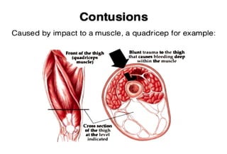 Contusions
Caused by impact to a muscle, a quadricep for example:
Front of the lhJgh
(quadriceps
muade)
{CroM Stttion
o( the thigh
rJ at the level
( Indicated
Blunt trauma lo the thigh
lh&t aLdn bleeding deep
w ithin the muscle
 