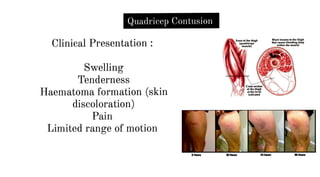 Quadricep Contusion
Clinical Presentation :
Swelling
Tenderness
Haematoma formation (skin
discoloration)
Pain
Limited range of motion
Blunt traWM lo tM lh.Jgh
INI CIUHSblttdlft8 dttp
within the 11111.sde
 