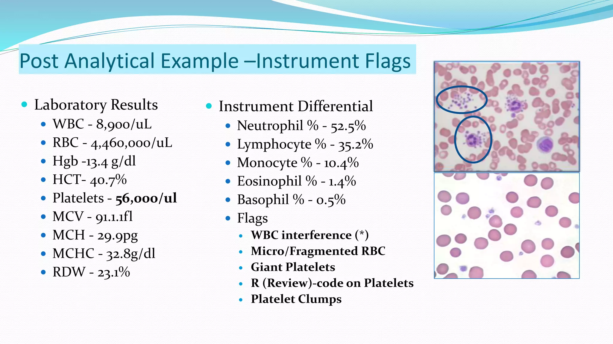Post Analytical Example –Instrument Flags
 Laboratory Results
 WBC - 8,900/uL
 RBC - 4,460,000/uL
 Hgb -13.4 g/dl
 HCT- 40.7%
 Platelets - 56,000/ul
 MCV - 91.1.1fl
 MCH - 29.9pg
 MCHC - 32.8g/dl
 RDW - 23.1%
 Instrument Differential
 Neutrophil % - 52.5%
 Lymphocyte % - 35.2%
 Monocyte % - 10.4%
 Eosinophil % - 1.4%
 Basophil % - 0.5%
 Flags
 WBC interference (*)
 Micro/Fragmented RBC
 Giant Platelets
 R (Review)-code on Platelets
 Platelet Clumps
 