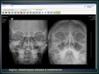 ATENDIMENTO DE EMERGÊNCIALúcida, orientada, eupneica, afebril, acianótica, anictérica  sem foco motor, sem rigidez de nuca,  hipocorada 1+\4+, desidratada 1+/4+RCR 2T BNF sem Sopros ou ESMVUA sem ruídos adventíciosAbdome e MMII sem alteraçõesTratamento : Dipirona, Profenid, Tramal sem controle álgicoTCC: NormalRX Seios Face: EXS: sem leucocitoseConduta: Internação em quarto para controle álgico, observação estudo e tratamento.