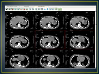 CONDUTASolicitado:Hemograma, bioquímica, PCR, LDLVDRLVHST4 livre, TSHAldolaseCombs direta e indiretaSorologia para dengue e hepatite CFunção HepáticaGasometria com lactatoHIVPunção LombarTCTXPRESCRITO HIDANTALPRESCRITO MACRO CONTINUA