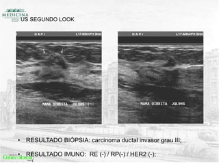 US SEGUNDO LOOK
• RESULTADO BIÓPSIA: carcinoma ductal invasor grau III;
• RESULTADO IMUNO: RE (-) / RP(-) / HER2 (-);
 