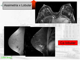 Assimetria x Lobular
 