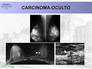 CARCINOMA OCULTO
 