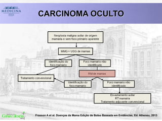 CARCINOMA OCULTO
Frasson A et al. Doenças da Mama Edição de Bolso Baseada em Evidências, Ed. Atheneu, 2013
 