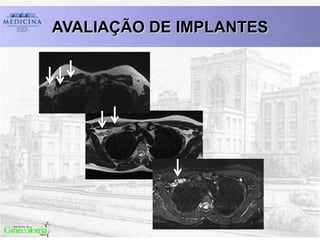 AVALIAÇÃO DE IMPLANTES
 