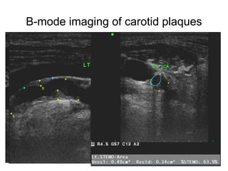 B-mode imaging of carotid plaques

                  • Intima-media
                    thickness (IMT)
                  • Fatty streak or
                    soft plaques
                  • Small non-
                    stenotic plaque
 