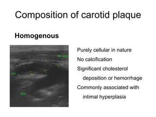 Composition of carotid plaque

Homogenous
              Purely cellular in nature
              No calcification
              Significant cholesterol
                deposition or hemorrhage
              Commonly associated with
                intimal hyperplasia
 