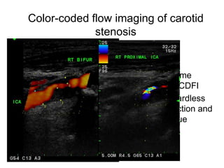 Color-coded flow imaging of carotid
             stenosis

                   Power mode
                   • Used for same
                     purpose of CDFI
                   • display regardless
                     of flow direction and
                     velocity value
 