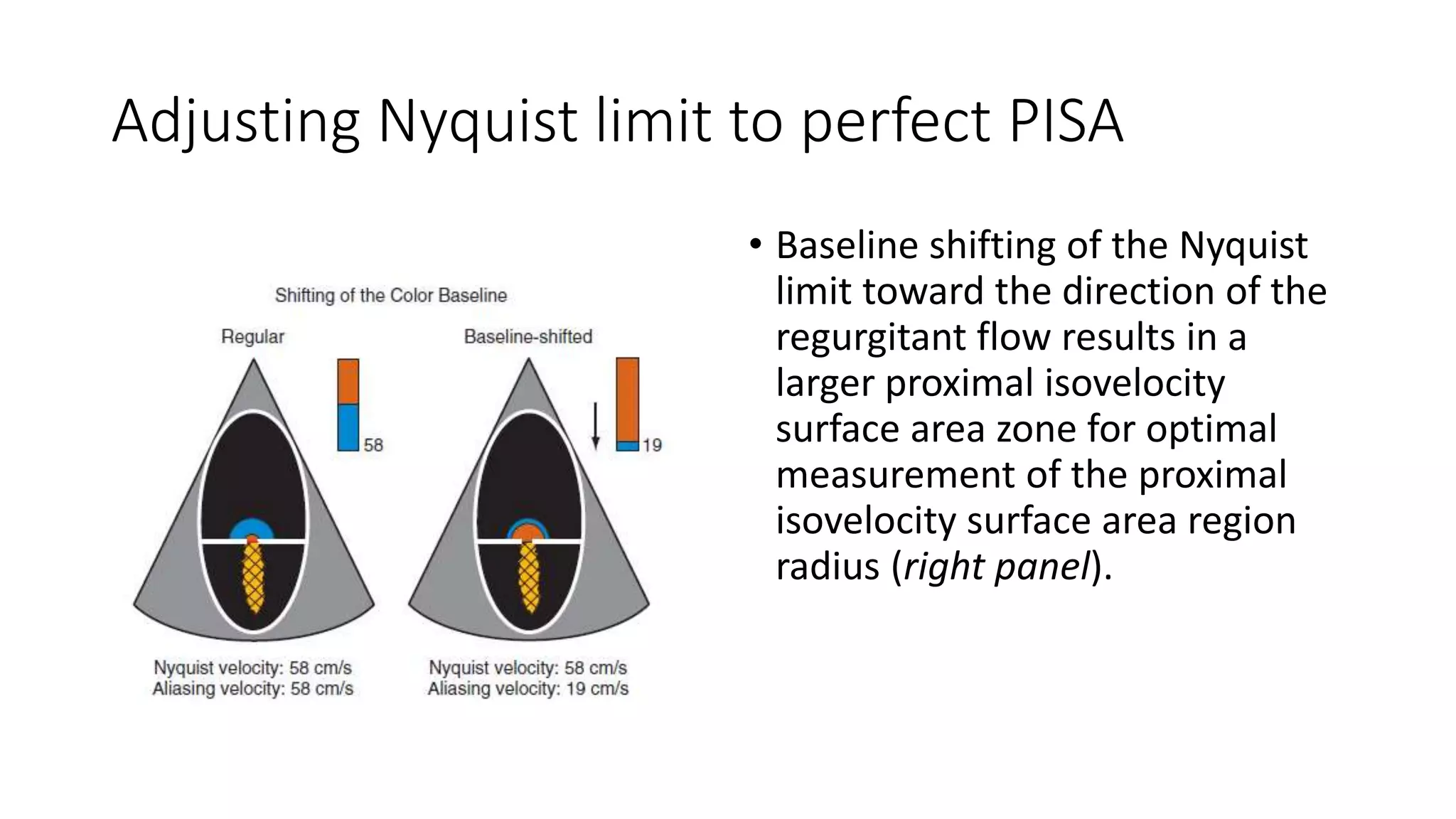 Quantification of mitral regurgitation by PISA | PPTX