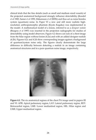 Assessment of image quality 
clinical trials that the fine details (such as small and medium sized vessels) of 
the projected anatomical background strongly influence detectability (Kundel 
et al 1985, Samei et al 1999, Håkansson et al 2005b) and thus act as noise besides 
system  (quantum)  noise.  In  Paper  VI  a  new  and  still  more  realistic  high‐
resolution  anthropomorphic  phantom  (Kyoto  Kagaku)  was  implemented  in 
the model. A mathematical model of a lesion, referred to as a designer nodule 
(Burgess et al 1997) was inserted in the projection radiographs for studies of 
detectability using model observers. Figure 4.2 shows cut outs of a chest image 
from the hilar region without lesion (4.2a) and with an added designer nodule 
(4.2b). Figures 4.2c and 4.2d show corresponding images against a background 
of  quantum/system  noise  only.  The  figures  clearly  demonstrate  the  large 
difference  in  difficulty  between  detecting  a  nodule  in  an  image  containing 
anatomical structures and in a pure quantum noise image, respectively. 
 
 
 
 
Figure 4.1. The six anatomical regions of the chest PA image used in papers III 
and VI: APR: Apical pulmonary region, LAT: Lateral pulmonary region, RET: 
Retrocardial  region,  LME:  Lower  mediastinal  region,  HIL:  Hilar  region  and 
UME: Upper mediastinal region.  
 
 
 
 
 
 
  28
 