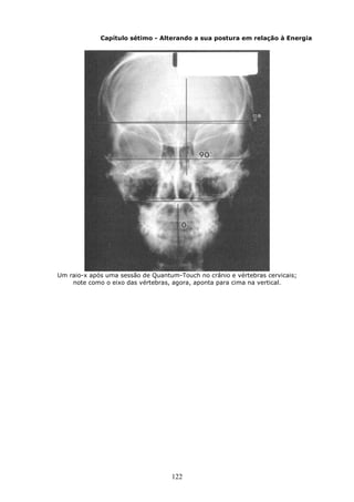 122
Capítulo sétimo - Alterando a sua postura em relação à Energia
Um raio-x após uma sessão de Quantum-Touch no crânio e vértebras cervicais;
note como o eixo das vértebras, agora, aponta para cima na vertical.
 