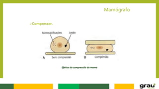 Mamógrafo
Compressor.
Efeitos da compressão da mama
 