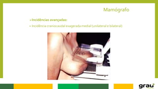 Mamógrafo
Incidências avançadas:
• Incidência craniocaudal exagerada medial (unilateral e bilateral)
 