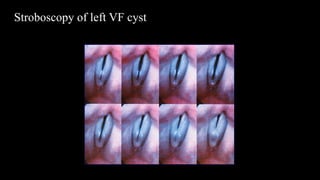 Stroboscopy of left VF cyst
 