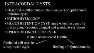 INTRACORDAL CYSTS
• Classified as either mucus retention cysts or epidermoid
inclusion cysts
•PATHOPHYSIOLOGY-
• MUCUS RETENTION CYST- arise when the duct of a
mucus gland becomes plugged and glandular secretions
•EPIERMOID INCLUSION CYST-
contain accumulated keratin
Healing of injured mucosa
Epithelial cell rests in
subepithelial layer
 