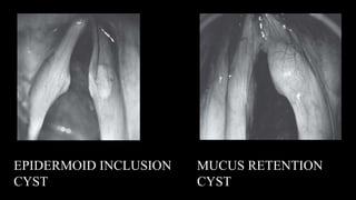EPIDERMOID INCLUSION
CYST
MUCUS RETENTION
CYST
 