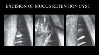 EXCISION OF MUCUS RETENTION CYST
 