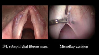 B/L subepithelial fibrous mass Microflap excision
 