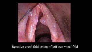 Reactive vocal fold lesion of left true vocal fold
 