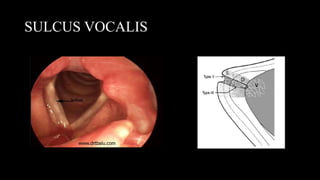 SULCUS VOCALIS
 
