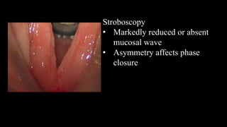 Stroboscopy
• Markedly reduced or absent
mucosal wave
• Asymmetry affects phase
closure
 