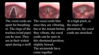 The vocal cords are
apart for breathing
in. The rings of the
trachea (wind pipe)
can be seen. They
are at their widest
apart during a sniff.
The vocal cords blur
once they are vibrating,
but at the instant before
they vibrate, the vocal
cords can be seen in
this shortened position,
slightly bowed.
The arytenoids have
come together
At a high pitch, at
the onset of
phonation, the vocal
cords are stretched.
 