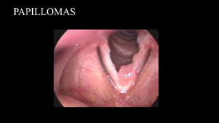 PAPILLOMAS
 