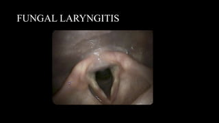 FUNGAL LARYNGITIS
 