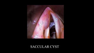 SACCULAR CYST
 