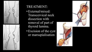 TREATMENT:
•External/mixed:
Transcervical neck
dissection with
removal of part of
thyroid lamina.
•Excision of the cyst
or marsupialisation
 