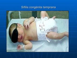 Sífilis congénita temprana 