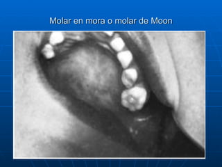 Molar en mora o molar de Moon 