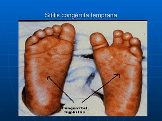 Sífilis congénita temprana 