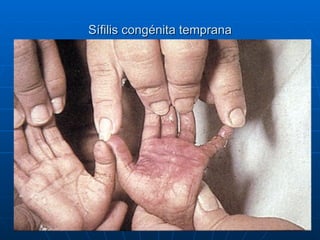 Sífilis congénita temprana 